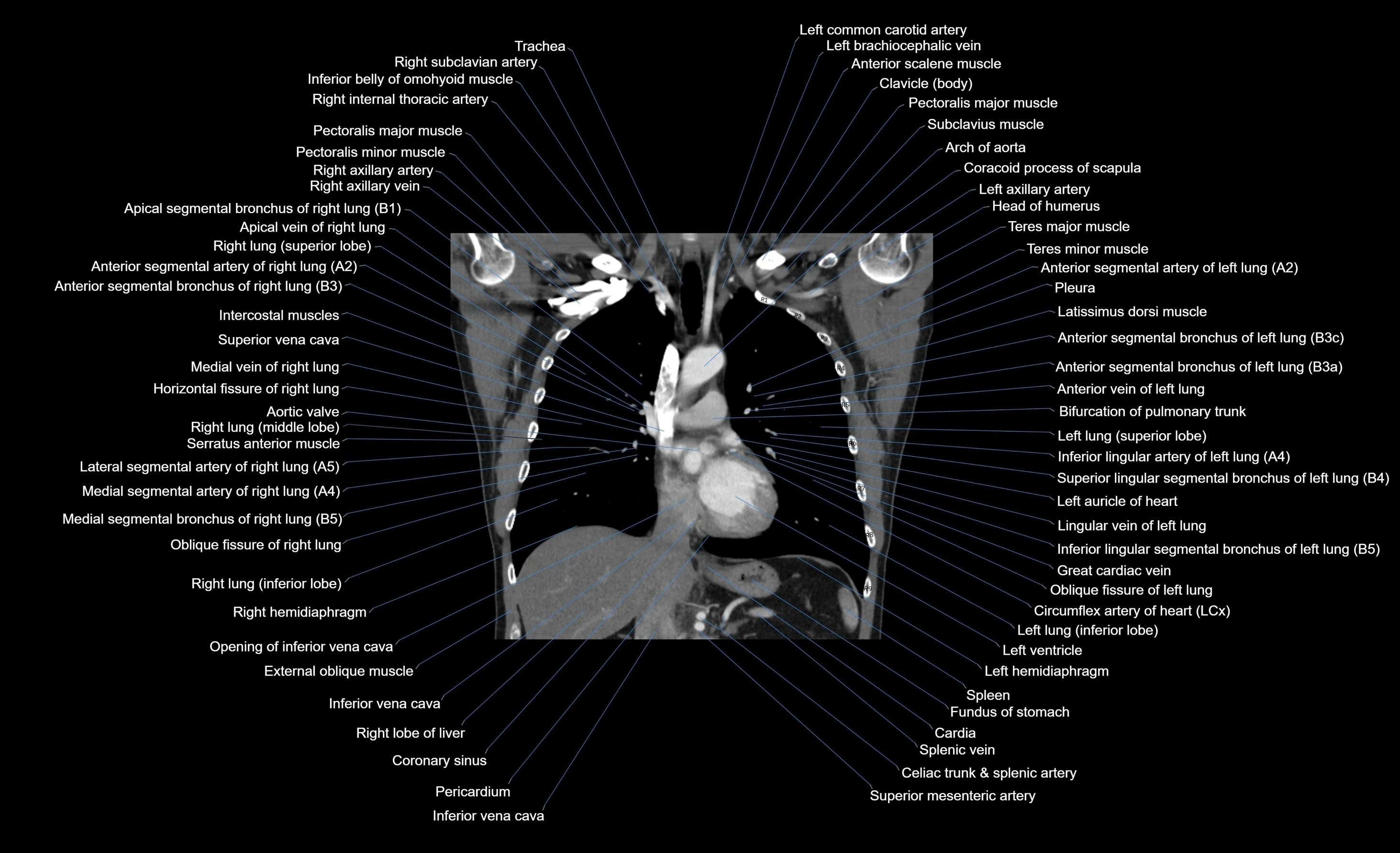 CT chest (thorax) soft tissue window labelled coronal cross sectional anatomy radiology image-00065.webp